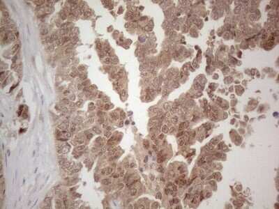 Immunohistochemistry: SPATA22 Antibody (6H9) [NBP2-45939] - Analysis of Adenocarcinoma of Human ovary tissue. (Heat-induced epitope retrieval by 1mM EDTA in 10mM Tris buffer (pH8.5) at 120C for 3 min)