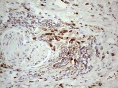 Immunohistochemistry: SPATA22 Antibody (6H9) [NBP2-45939] - Analysis of Carcinoma of Human bladder tissue. (Heat-induced epitope retrieval by 1mM EDTA in 10mM Tris buffer (pH8.5) at 120C for 3 min)