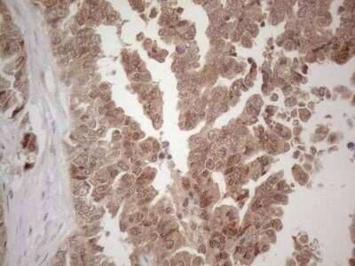 Immunohistochemistry: SPATA22 Antibody (OTI6H9) - Azide and BSA Free [NBP2-74309] - Analysis of Adenocarcinoma of Human ovary tissue. (Heat-induced epitope retrieval by 1mM EDTA in 10mM Tris buffer (pH8.5) at 120C for 3 min)