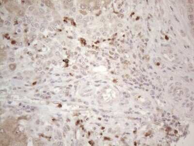Immunohistochemistry: SPATA22 Antibody (OTI6H9) - Azide and BSA Free [NBP2-74309] - Analysis of Carcinoma of Human liver tissue.(Heat-induced epitope retrieval by 1mM EDTA in 10mM Tris buffer (pH8.5) at 120C for 3 min)