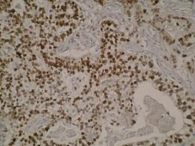 Immunohistochemistry: SPATA25 Antibody (Z37P3H11/B2) [NBP2-50305] - Analysis of aoesophageal cancer tissue cross sections. Nuclear staining was observed.