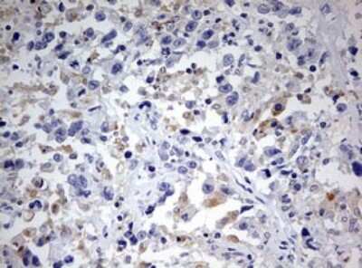 Immunohistochemistry: SPATA2L Antibody (3F6) [NBP2-45940] - Analysis of Adenocarcinoma of Human ovary tissue.