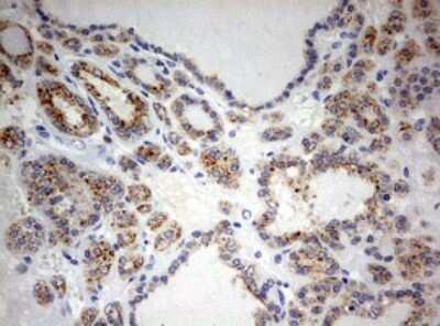 Immunohistochemistry: SPATA2L Antibody (3F6) [NBP2-45940] - Analysis of Carcinoma of Human thyroid tissue.