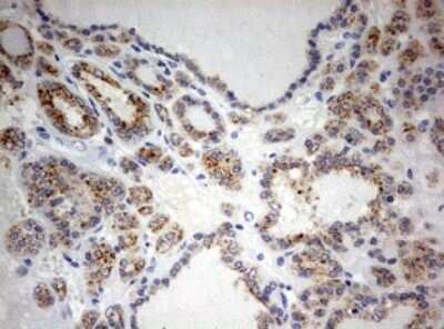 Immunohistochemistry: SPATA2L Antibody (OTI3F6) - Azide and BSA Free [NBP2-74310] - Analysis of Carcinoma of Human thyroid tissue.