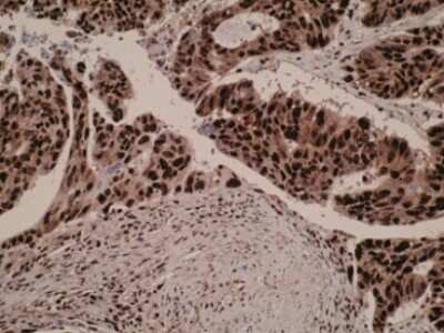 Immunohistochemistry-Paraffin: SPATA2L Antibody (Z2P2D5/C8) [NBP2-50306] - Positive immunostaining is observed in colorectal cancer tissue sections and staining is predominately nuclear.