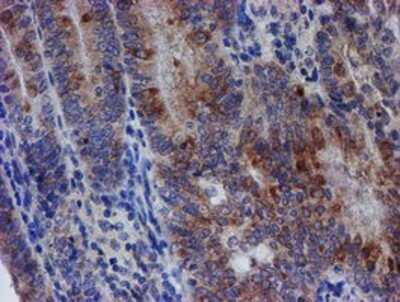 Immunohistochemistry: SPATC1L Antibody (OTI1H6) - Azide and BSA Free [NBP2-72277] - Staining of paraffin-embedded Adenocarcinoma of Human endometrium tissue using anti-C21orf56 mouse monoclonal antibody.