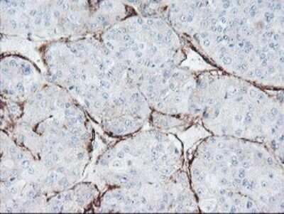 Immunohistochemistry: SPG7 Antibody (OTI1G4) - Azide and BSA Free [NBP2-74323] - Analysis of Carcinoma of Human liver tissue. (Heat-induced epitope retrieval by 10mM citric buffer, pH6.0, 120C for 3min)