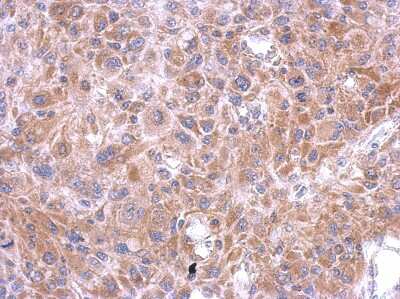 Immunohistochemistry-Paraffin: Testican 3/SPOCK3 Antibody [NBP2-20476] - U373 xenograft, using SPOCK3 antibody at 1:500 dilution. Antigen Retrieval: Trilogy™ (EDTA based, pH 8.0) buffer, 15min. 