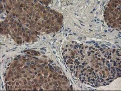 Immunohistochemistry: SPR Antibody (OTI4F5) - Azide and BSA Free [NBP2-74344] - Staining of paraffin-embedded Adenocarcinoma of Human breast tissue using anti-SPR mouse monoclonal antibody.