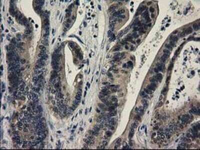 Immunohistochemistry: SPR Antibody (OTI4F5) - Azide and BSA Free [NBP2-74344] - Staining of paraffin-embedded Adenocarcinoma of Human colon tissue using anti-SPR mouse monoclonal antibody.