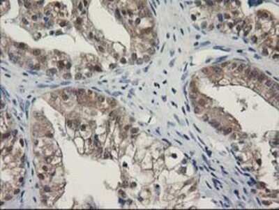 Immunohistochemistry: SPR Antibody (OTI4F5) - Azide and BSA Free [NBP2-74344] - Staining of paraffin-embedded Adenocarcinoma of Human ovary tissue using anti-SPR mouse monoclonal antibody.