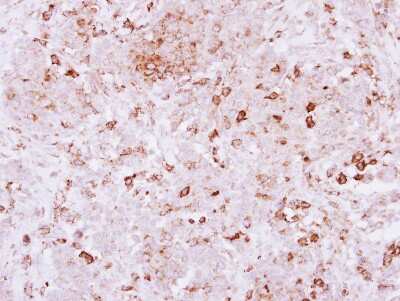 Immunohistochemistry-Paraffin: SPRED2 Antibody [NBP2-20478] - Immunohistochemical analysis of paraffin-embedded Breast ca, using antibody at 1:500 dilution.