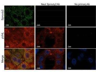 Immunohistochemistry-Paraffin: SPRY2 Antibody [NBP2-13158] - Immunohistochemistry-Paraffin: Sprouty 2 - Tissue: human kidney clear cell tumor. Fixation: formalin fixed, paraffin embedded. Antigen retrieval: yes. Primary antibody: Sprouty2 antibody at 1:250. Secondary antibody: alexafluor 488 secondary at 1:500 overnight at 4C. Localization: nucleus and cytoplasm. Staining: green = sprouty2, Blue = dapi, red= vhl.