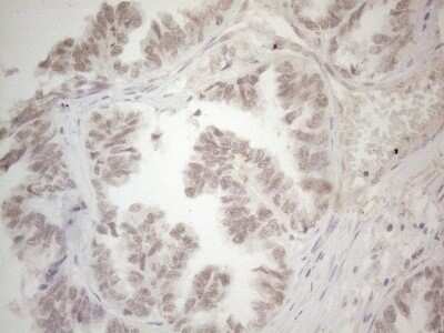 Immunohistochemistry: SPT3 Antibody (OTI1A5) - Azide and BSA Free [NBP2-74348] - Analysis of Adenocarcinoma of Human ovary tissue. (Heat-induced epitope retrieval by 1mM EDTA in 10mM Tris buffer (pH8.5) at 120C for 3 min)