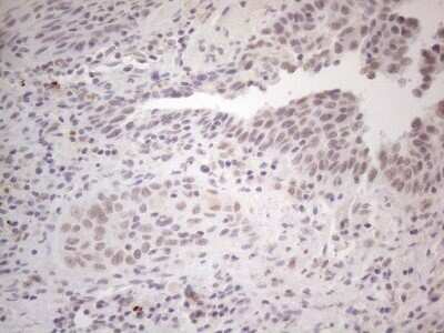 Immunohistochemistry: SPT3 Antibody (OTI1A5) - Azide and BSA Free [NBP2-74348] - Analysis of Carcinoma of Human bladder tissue. (Heat-induced epitope retrieval by 1mM EDTA in 10mM Tris buffer (pH8.5) at 120C for 3 min)