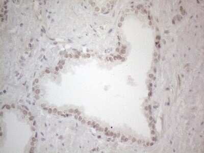 Immunohistochemistry: SPT3 Antibody (OTI1A5) - Azide and BSA Free [NBP2-74348] - Analysis of Carcinoma of Human prostate tissue. (Heat-induced epitope retrieval by 1mM EDTA in 10mM Tris buffer (pH8.5) at 120C for 3 min)