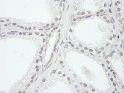 <b>Biological Strategies Validation. </b>Immunohistochemistry: SRC1 Antibody [NB100-312] - Sample: FFPE section of human prostate carcinoma. Antibody: Affinity purified rabbit anti- SRC1 used at a dilution of 1:1,000 (1ug/ml). Detection: DAB. Counterstain: IHC Hematoxylin (blue).