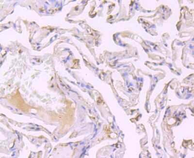 Immunohistochemistry-Paraffin: SRC1 Antibody (JB66-31) [NBP2-75672] - Analysis of paraffin-embedded human lung cancer tissue using anti-SRC1 antibody. Counter stained with hematoxylin.