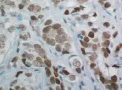 Immunohistochemistry-Paraffin: SRC1 Antibody (JB66-31) [NBP2-75672] - PFA fixed, paraffin-embedded human prostate cancer tissue sections. Heat-mediated antigen retreival was performed for 30 minutes in citrate buffer. IHC-P image submitted by a verified customer review.