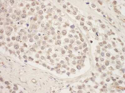 <b>Independent Antibodies Validation. </b>Immunohistochemistry-Paraffin: SRPK1 Antibody [NBP1-30108] - Section of human testicular seminoma. Antibody: Affinity purified rabbit anti- SRPK1 used at a dilution of 1:200 (1ug/ml). Detection: DAB