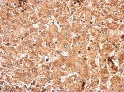 Immunohistochemistry-Paraffin: SRPK3/STK23 Antibody [NBP2-20515] - STK23 antibody detects SRPK3 protein at cytosol on human hepatoma  dilution: 1:500. Antigen Retrieval: Trilogy™ (EDTA based, pH 8.0) buffer, 15min