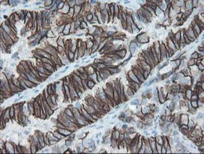 Immunohistochemistry-Paraffin: SRPRB Antibody (1D9) [NBP2-02028] - Staining of paraffin-embedded Adenocarcinoma of Human ovary tissue using anti-SRPRB mouse monoclonal antibody.