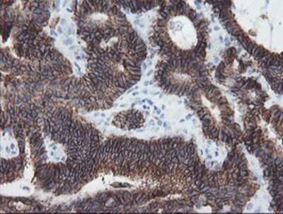 Immunohistochemistry: SRPRB Antibody (OTI1D9) - Azide and BSA Free [NBP2-74350] - Staining of paraffin-embedded Adenocarcinoma of Human colon tissue using anti-SRPRB mouse monoclonal antibody.