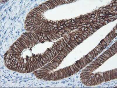 Immunohistochemistry: SRPRB Antibody (OTI1D9) - Azide and BSA Free [NBP2-74350] - Staining of paraffin-embedded Adenocarcinoma of Human endometrium tissue using anti-SRPRB mouse monoclonal antibody.