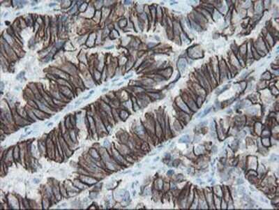 Immunohistochemistry: SRPRB Antibody (OTI1D9) - Azide and BSA Free [NBP2-74350] - Staining of paraffin-embedded Adenocarcinoma of Human ovary tissue using anti-SRPRB mouse monoclonal antibody.