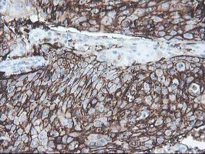 Immunohistochemistry: SRPRB Antibody (OTI1D9) - Azide and BSA Free [NBP2-74350] - Staining of paraffin-embedded Carcinoma of Human bladder tissue using anti-SRPRB mouse monoclonal antibody.