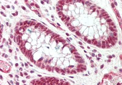 Immunohistochemistry-Paraffin: SRRM1 Antibody [NBP2-85821] - Rabbit Anti-Srrm1 antibody. Formalin Fixed Paraffin Embedded Tissue: Human Colon. Primary antibody Concentration: 1:100. Secondary Antibody: Donkey anti-Rabbit-Cy3. Secondary Antibody Concentration: 1:200. Magnification: 20x. Exposure Time: 0.5-2.0sec