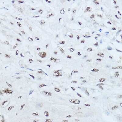 Immunohistochemistry-Paraffin: SRRM1 Antibody [NBP2-93715] - Immunohistochemistry of paraffin-embedded human esophageal cancer using SRRM1 Rabbit pAb (NBP2-93715) at dilution of 1:450 (40x lens). Perform high pressure antigen retrieval with 10 mM citrate buffer pH 6.0 before commencing with IHC staining protocol.