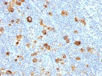 Immunohistochemistry-Paraffin: SSEA-1 Antibody (FUT4/1478R) [NBP2-54374] - Formalin-fixed, paraffin-embedded human Hodgkin's Lymphoma stained with CD15 Recombinant Rabbit Monoclonal Antibody (FUT4/1478R).