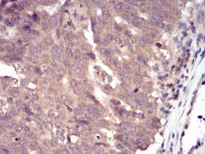 Immunohistochemistry-Paraffin: SSH1 Antibody (6C11G9) [NBP2-52568] - Analysis of ovarian cancer tissues using SLINGSHOT-1L mouse mAb with DAB staining.