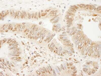 <b>Independent Antibodies Validation and Biological Strategies Validation.</b>Immunohistochemistry: SSH3 Antibody [NB100-60675] - Sample: FFPE section of human colon carcinoma. Antibody: Affinity purified rabbit anti- SSH3 used at a dilution of 1:200 (1ug/ml). Detection: DAB