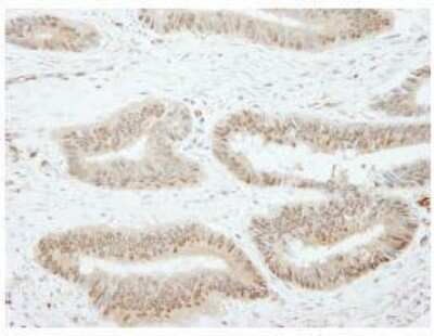 Immunohistochemistry-Paraffin: SSH3 Antibody [NB100-60675] - FFPE section of human colon carcinoma.  Affinity purified rabbit anti-SSH3 used at a dilution of 1:250.