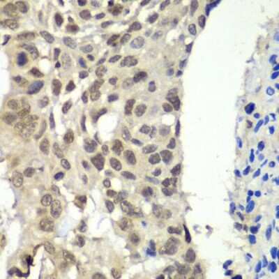 Immunohistochemistry-Paraffin: SSRP1 Antibody [NBP2-94578] -  Human esophageal cancer using SSRP1 antibody  at dilution of 1:100 (40x lens).Perform microwave antigen retrieval with 10 mM PBS buffer pH 7.2 before commencing with IHC staining protocol.