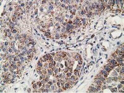 Immunohistochemistry: SSX1 Antibody (OTI1E10) - Azide and BSA Free [NBP2-74362] - Staining of paraffin-embedded Carcinoma of Human bladder tissue using anti-SSX1 mouse monoclonal antibody.