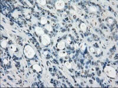 Immunohistochemistry-Paraffin: SSX2 Antibody (4D10) [NBP1-48008] - Staining of paraffin-embedded Adenocarcinoma of colon tissue using anti-SSX2 mouse monoclonal antibody.