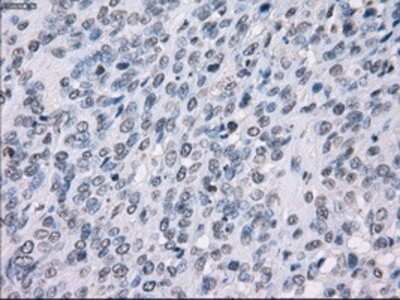 Immunohistochemistry-Paraffin: SSX2 Antibody (4D10) [NBP1-48008] - Staining of paraffin-embedded Carcinoma of bladder tissue using anti-SSX2 mouse monoclonal antibody.