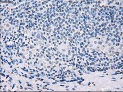 Immunohistochemistry-Paraffin: SSX2 Antibody (4D10) [NBP1-48008] - Staining of paraffin-embedded Carcinoma of thyroid tissue using anti-SSX2 mouse monoclonal antibody.