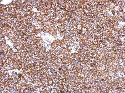 Immunohistochemistry-Paraffin: ST8SIA2 Antibody [NBP2-15129] - Paraffin-embedded PC13 xenograft, using antibody at 1:500 dilution.