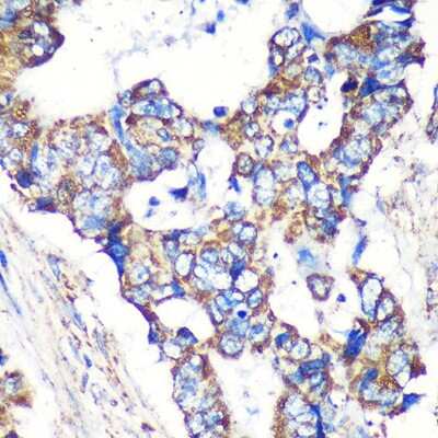 Immunohistochemistry-Paraffin: STARD3NL Antibody [NBP2-94673] - Immunohistochemistry of paraffin-embedded Human colon carcinoma using STARD3NL Rabbit pAb (NBP2-94673) at dilution of 1:100 (40x lens). Perform microwave antigen retrieval with 10 mM PBS buffer pH 7.2 before commencing with IHC staining protocol.