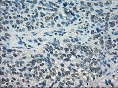 Immunohistochemistry-Paraffin: STAT1 Antibody (15H3) [NBP1-48013] - Staining of paraffin-embedded Carcinoma of bladder tissue using anti-STAT1 mouse monoclonal antibody.