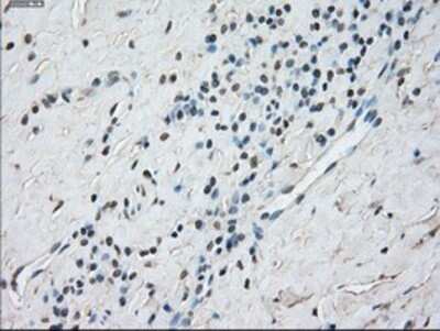 Immunohistochemistry: STAT1 Antibody (OTI4H9) - Azide and BSA Free [NBP2-74375] - Staining of paraffin-embedded Carcinoma of Human thyroid tissue using anti-STAT1 mouse monoclonal antibody.