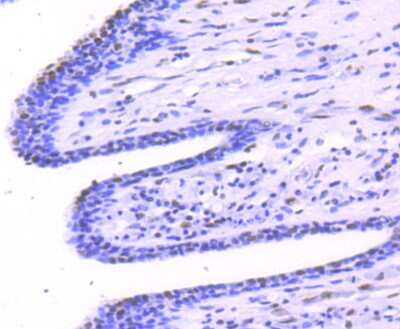 Immunohistochemistry-Paraffin: STAT1 [p Ser727] Antibody (SN67-04) [NBP2-67657] - Analysis of paraffin-embedded human breast carcinoma tissue using anti-Phospho-STAT1(S727) antibody. Counter stained with hematoxylin.