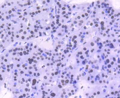 Immunohistochemistry-Paraffin: STAT1 [p Ser727] Antibody (SN67-04) [NBP2-67657] - Analysis of paraffin-embedded human liver cancer tissue using anti-Phospho-STAT1(S727) antibody. Counter stained with hematoxylin.
