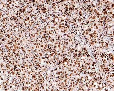 Immunohistochemistry-Paraffin: STAT1 [p Ser727] Antibody (SN67-04) [NBP2-67657] - Analysis of paraffin-embedded human liver carcinoma tissue with Rabbit anti-Phospho-STAT1 [p Ser727] antibody washed with ddH2O and PBS, and then probed with the primary antibody  at 1/500 dilution for 1 hour at room temperature. The detection was performed using an HRP conjugated compact polymer system. DAB was used as the chromogen. Tissues were counterstained with hematoxylin and mounted with DPX.