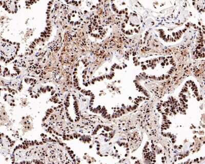 Immunohistochemistry-Paraffin: STAT1 [p Ser727] Antibody (SN67-04) [NBP2-67657] - Analysis of paraffin-embedded human lung carcinoma tissue with Rabbit anti-STAT1 [p Ser727] antibody washed with ddH2O and PBS, and then probed with the primary antibody at 1/500 dilution for 1 hour at room temperature. The detection was performed using an HRP conjugated compact polymer system. DAB was used as the chromogen. Tissues were counterstained with hematoxylin and mounted with DPX.