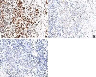 Immunohistochemistry-Paraffin: STAT1 [p Ser727] Antibody (SN67-04) [NBP2-67657] - Analysis of paraffin-embedded human breast invasive ductal tumor tissue with Rabbit anti-STAT1 [p Ser727] antibody washed with ddH2O and PBS, and then probed with the primary antibody  at 1/200 dilution for 1 hour at room temperature. The detection was performed using an HRP conjugated compact polymer system. DAB was used as the chromogen. Tissues were counterstained with hematoxylin and mounted with DPX.